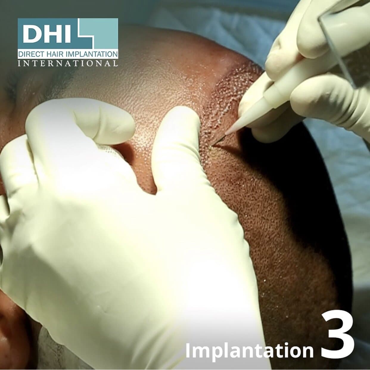 dhi hair transplant process 3 implantation