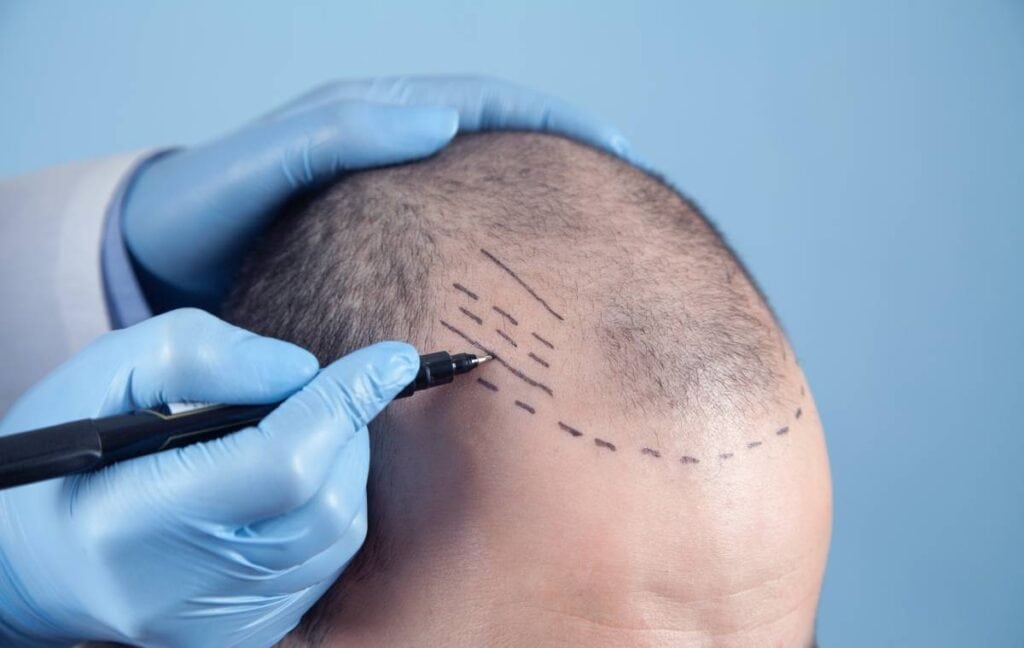patient suffering from hair loss in consultation with a doctor.