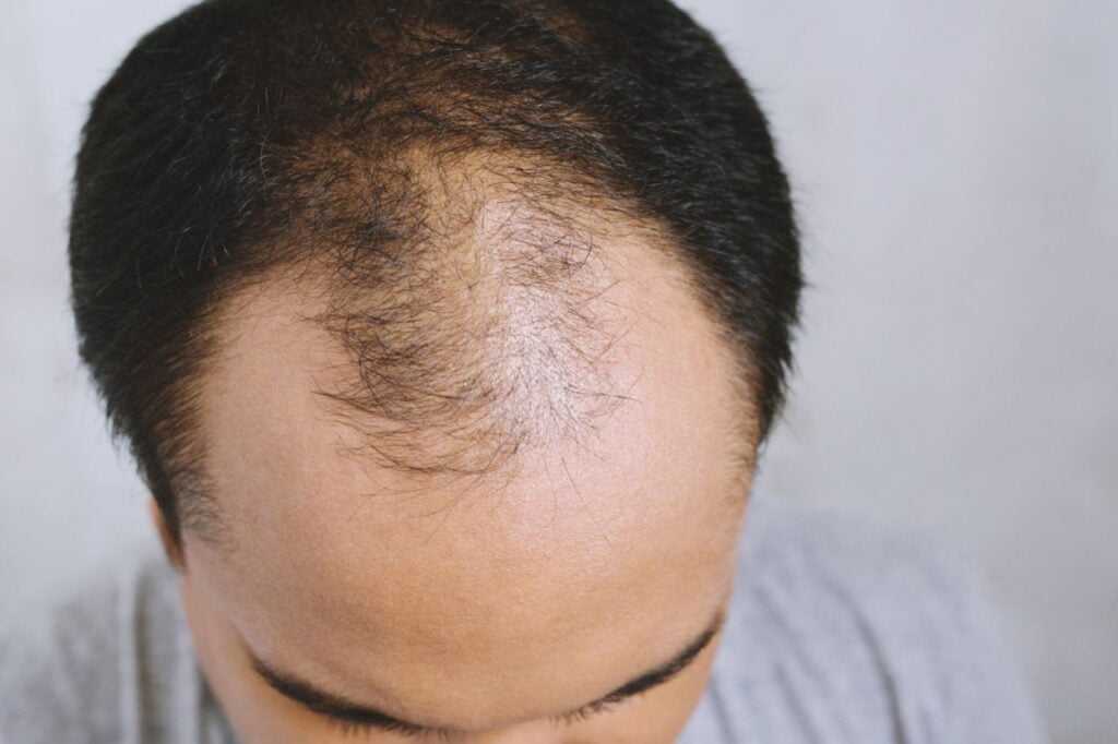 close up young man concerned with serious hair loss bald head thin scalp broken hair concept healthcare