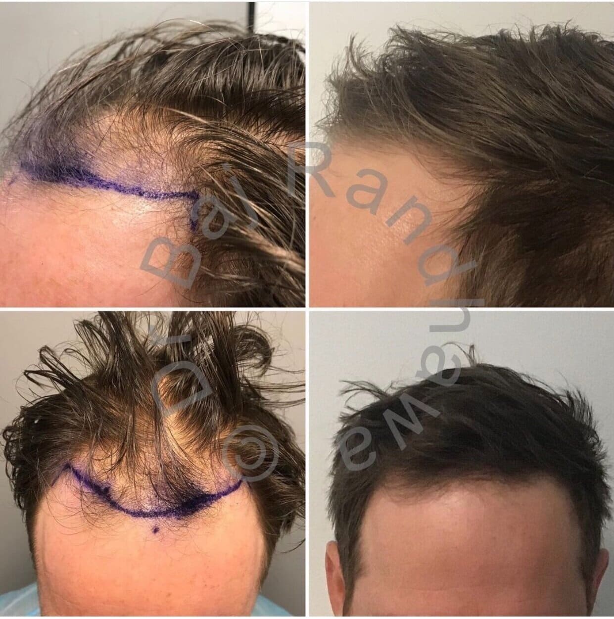hair-transplant-process-3200-Surgery hair transplant process 3200 surgery