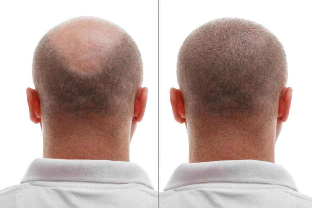 head balding man before after hair transplant surgery man losing his hair has become (1)