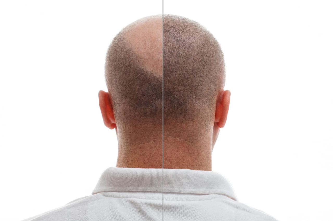 head balding man before after hair transplant surgery man losing his hair has become (2)