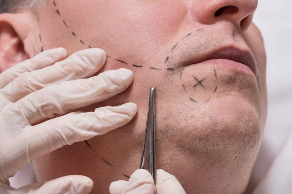 man beauty procedure beard hair implant senior man (1)