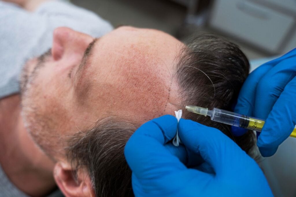 man getting hair loss treatment (3)