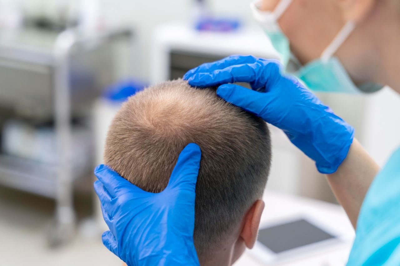 Can Hair Grow Back After Balding? Dr Hair